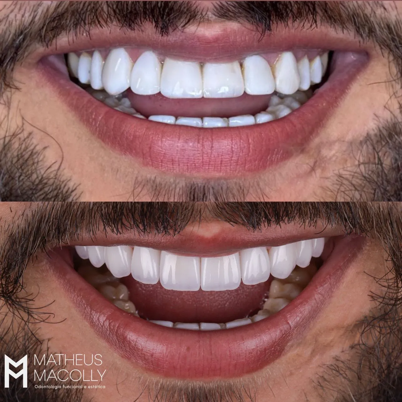 Resultado do tratamento: Lentes de Contato Ultrafinas