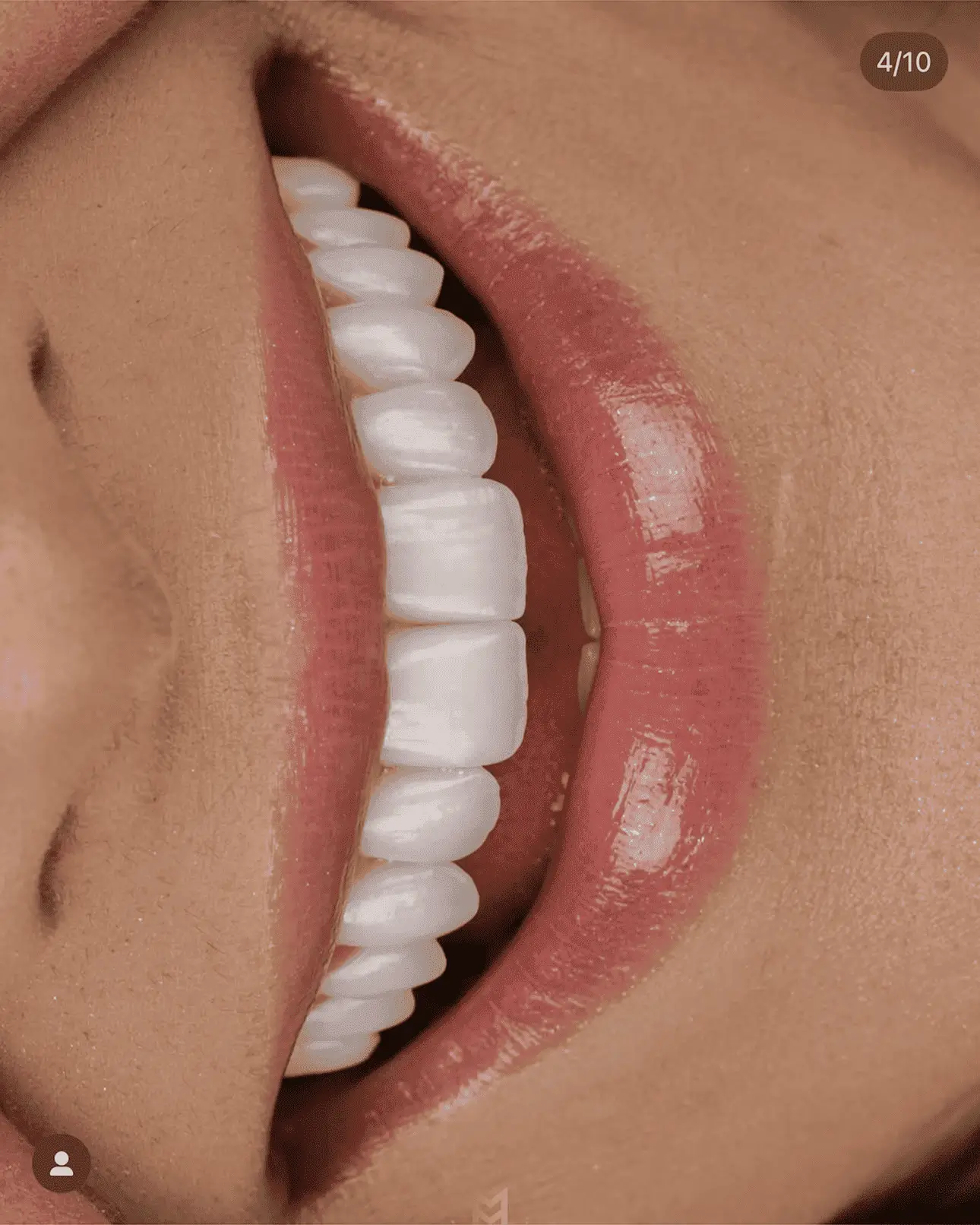 Resultado do tratamento: Sorrisos únicos e perfeitos planejados para cada paciente