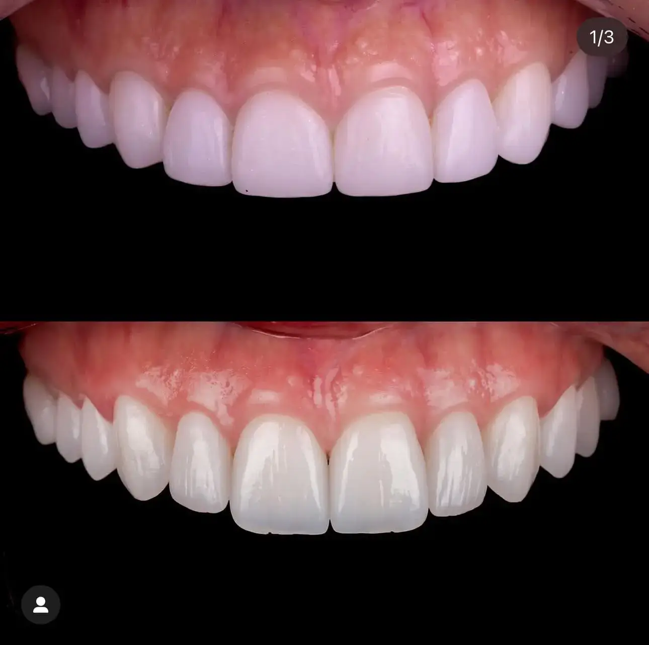 Resultado do tratamento: Troca de Lentes antigas por novas de alta tecnologia