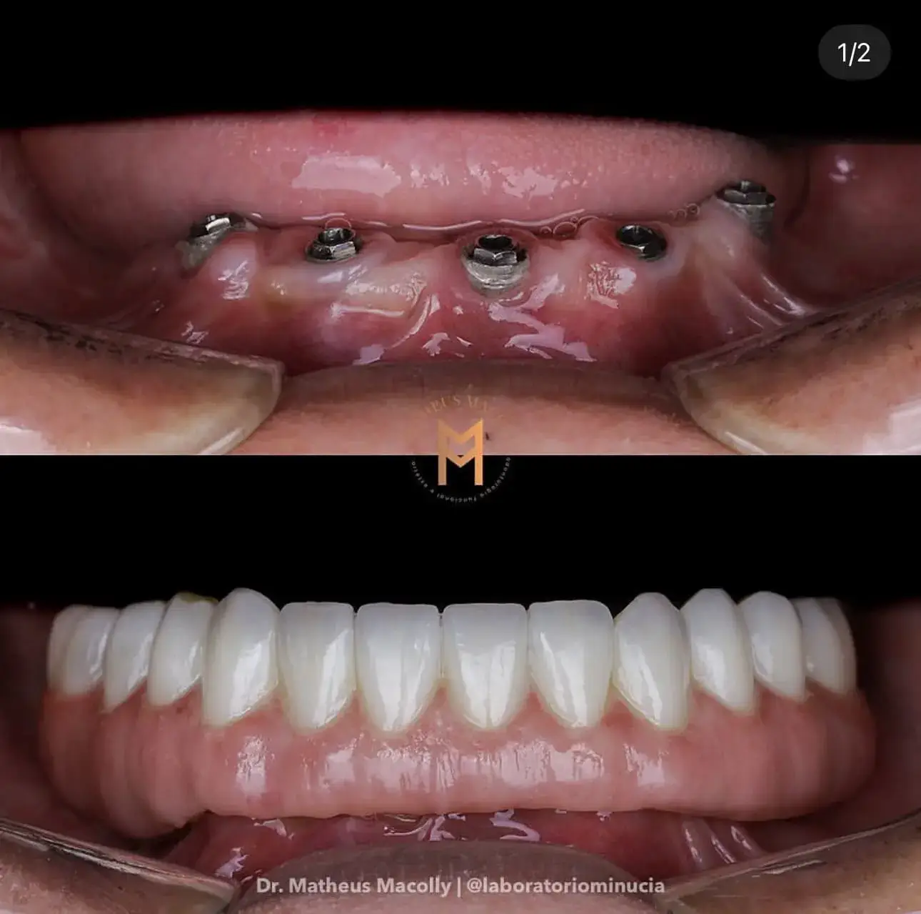 Resultado do tratamento: Protocolo de implantes em dois dias