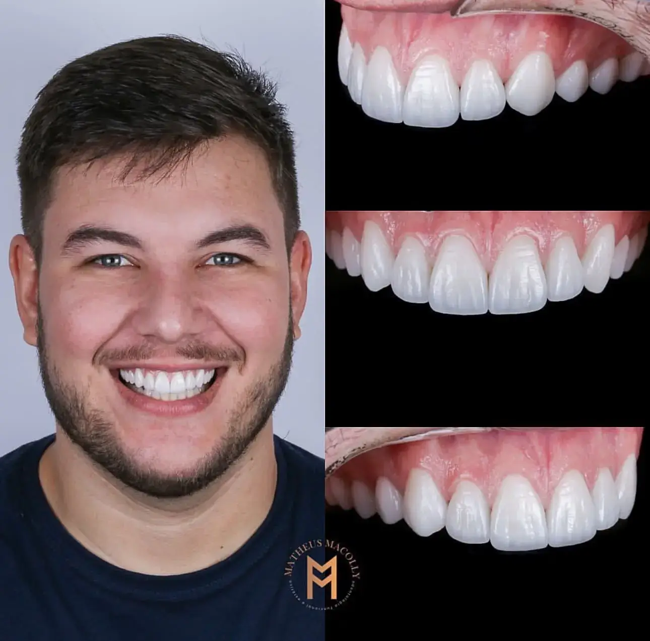 Resultado do tratamento: Lentes Com formato e cor naturais projetadas de acordo com o perfil facial de cada paciente