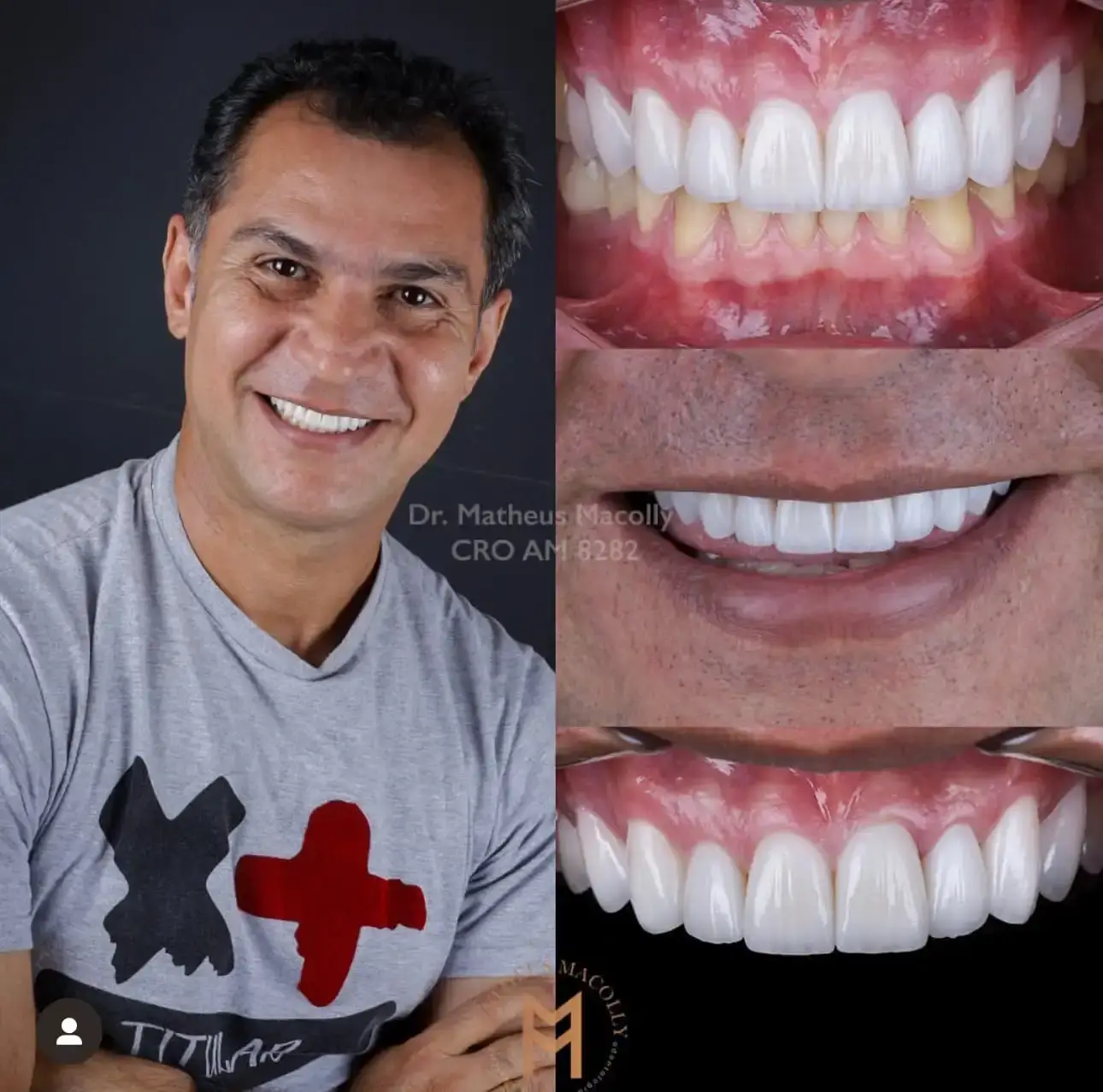 Resultado do tratamento: Lentes em 24horas para pacientes de outro estado