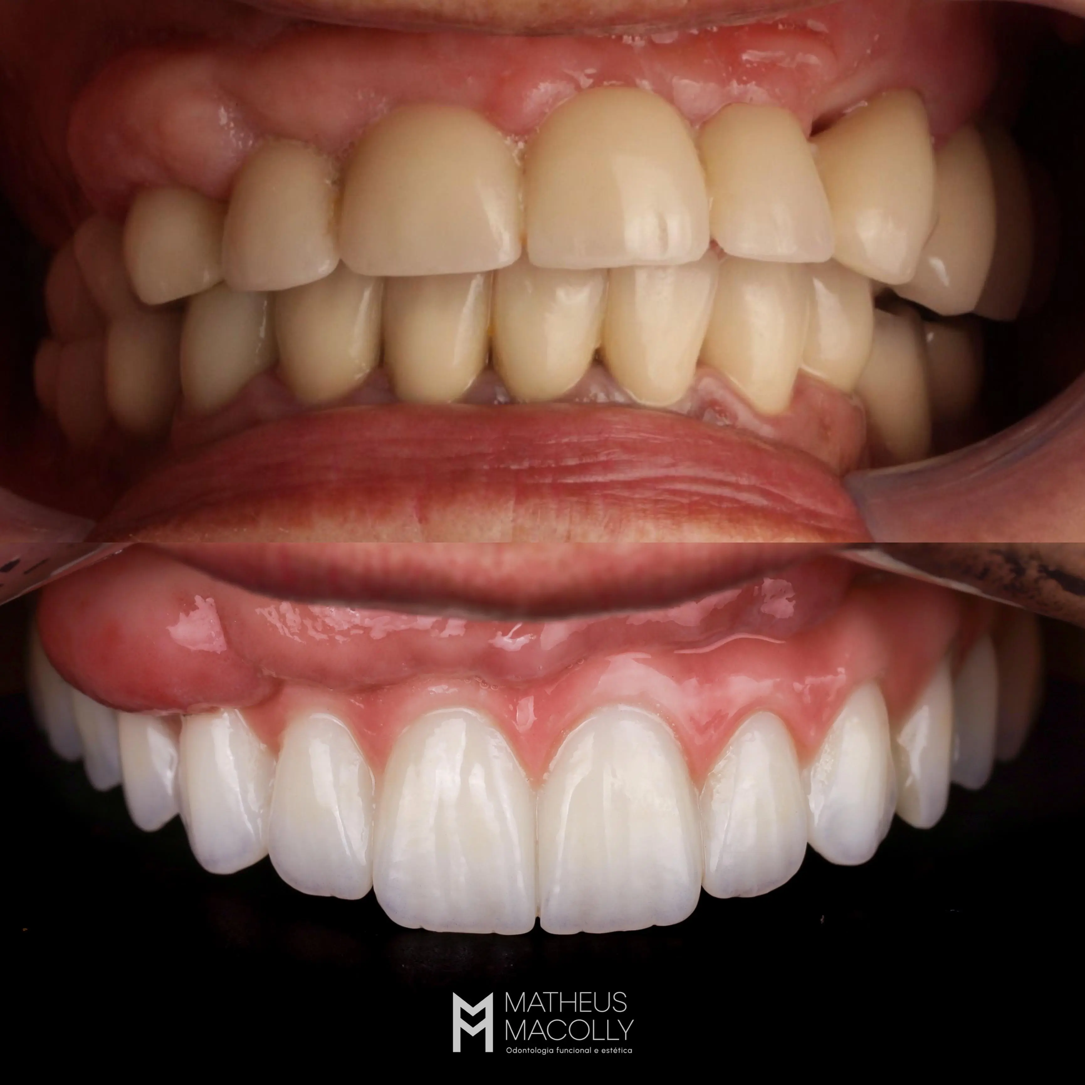 Resultado do tratamento: Protocolo de Implante