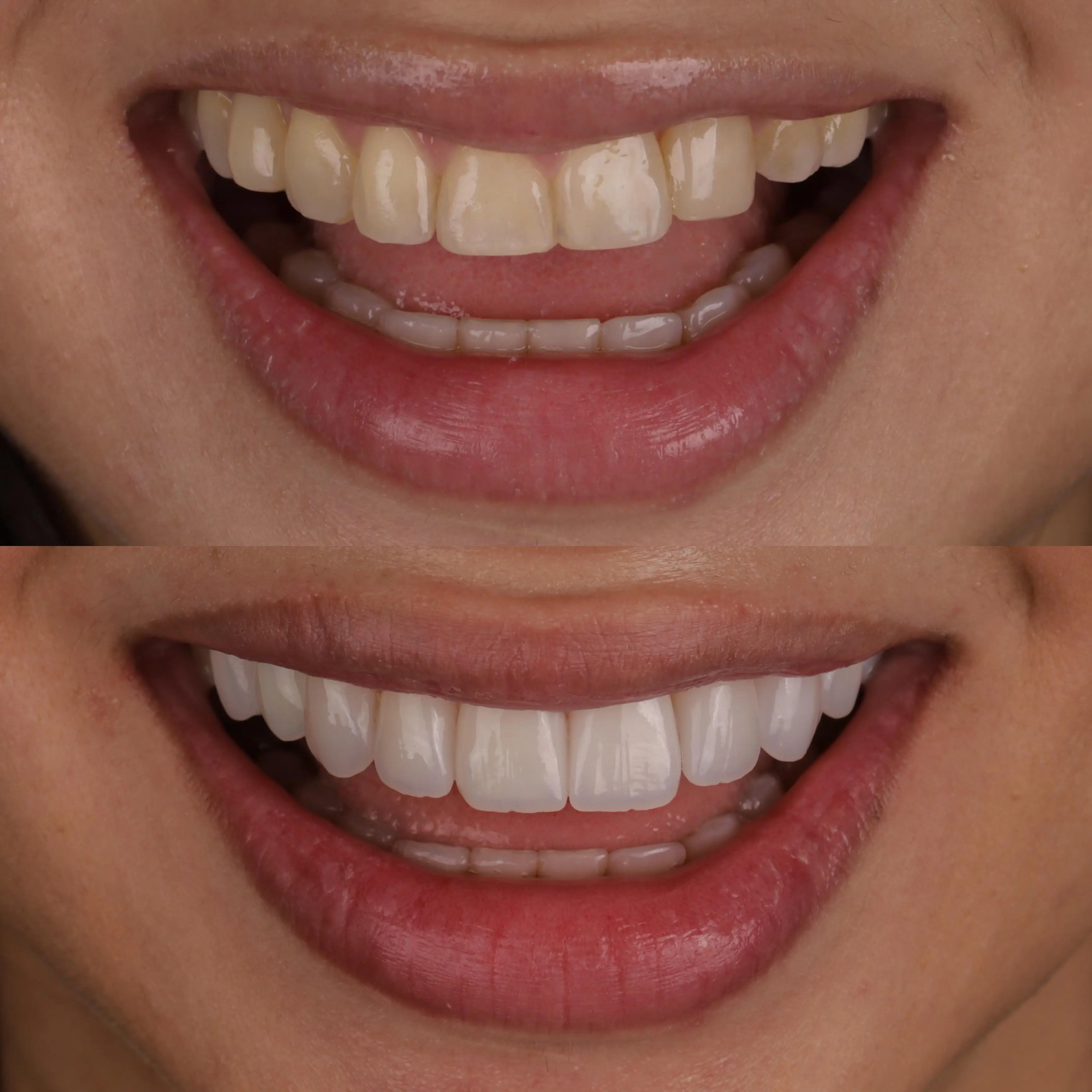 Resultado do tratamento: Lentes de Contato + Implante Dentário