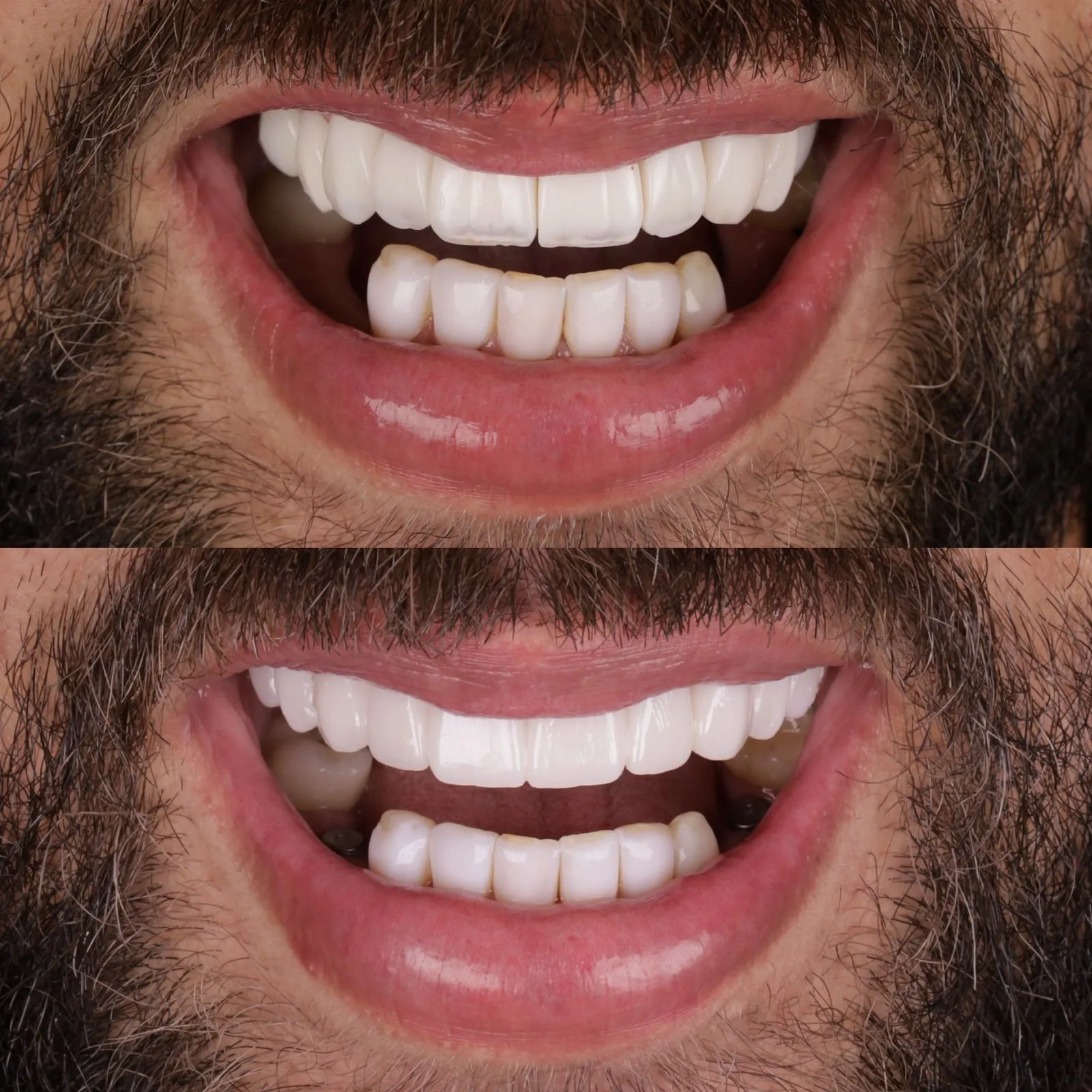 Resultado do tratamento: Lentes de Contato