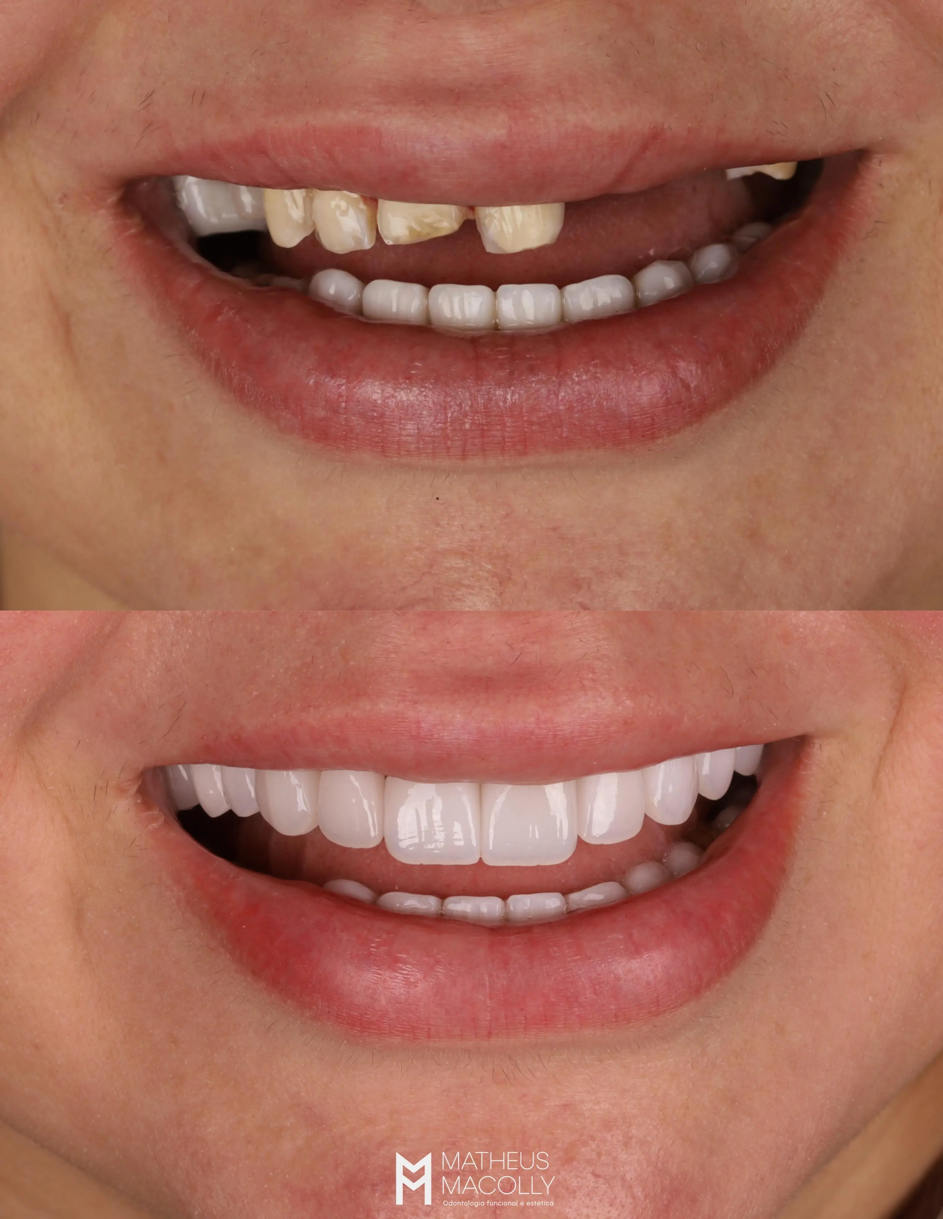 Resultado do tratamento: Lentes de Contato Perfeitas