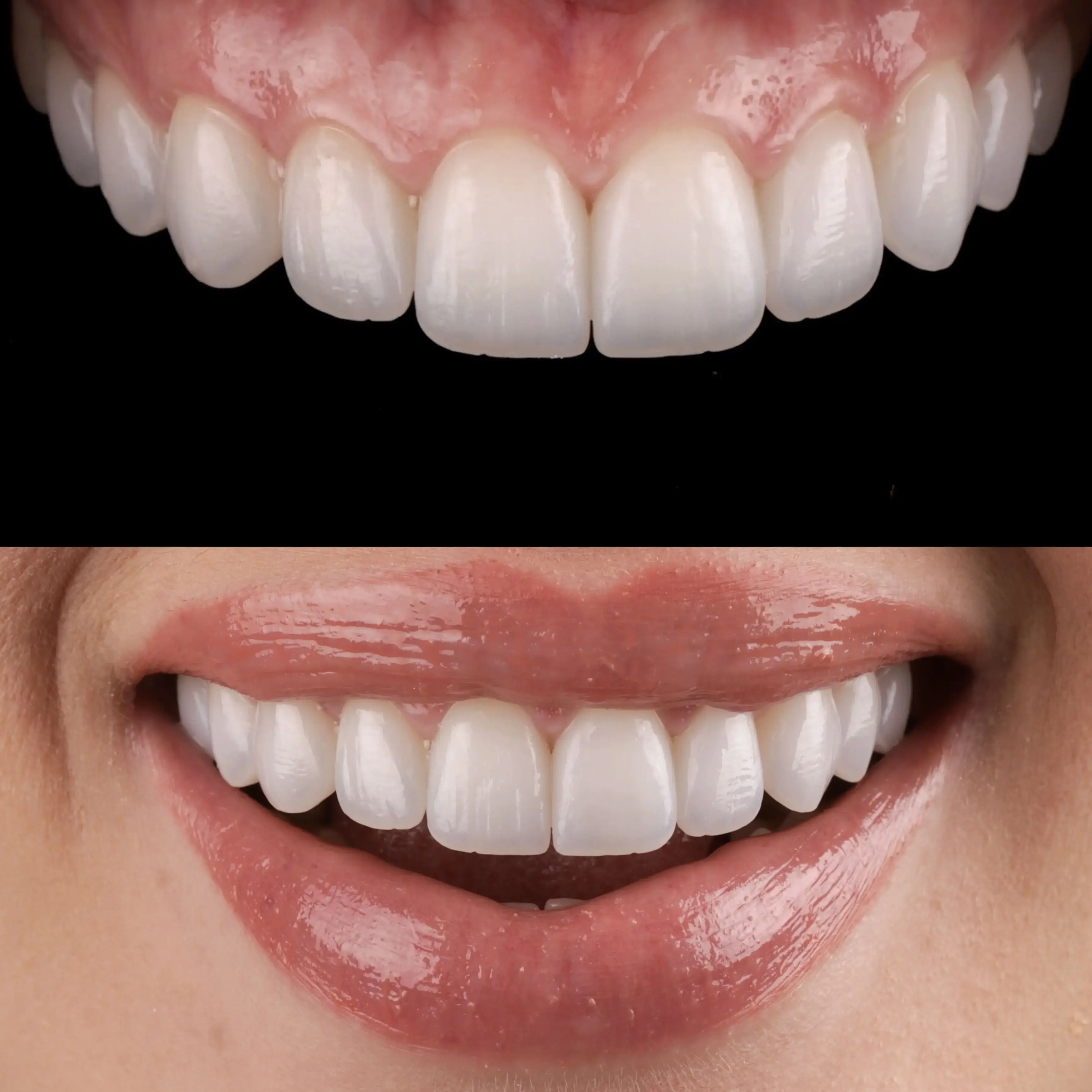 Resultado do tratamento: Lentes de Contato