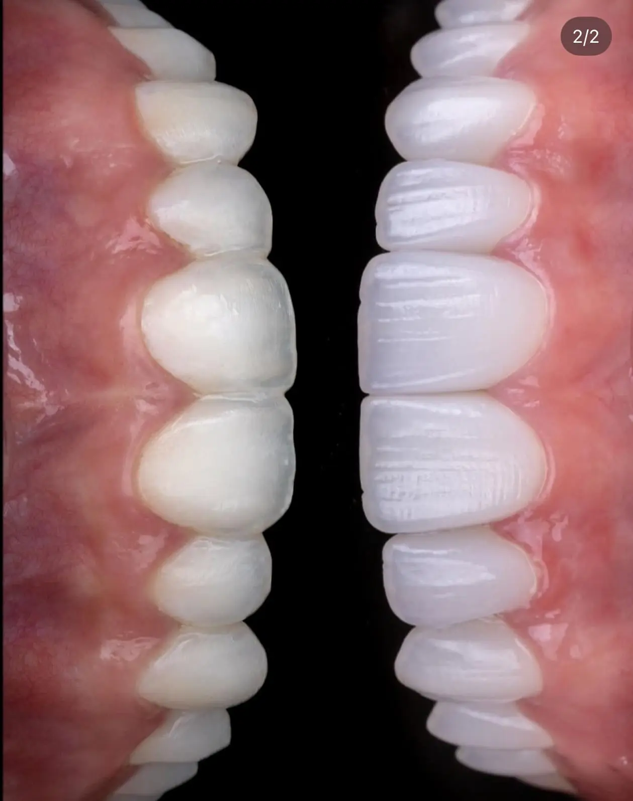 Resultado do tratamento: Lentes de contato com Harmonia