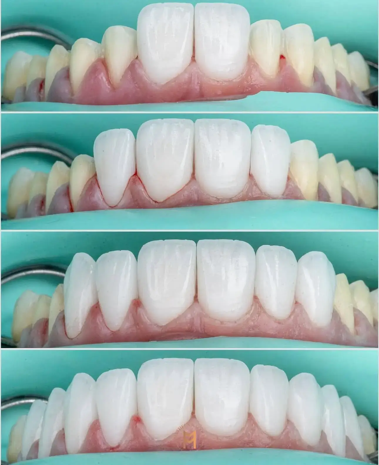 Resultado do tratamento: Desgastes minimamente invasivos para manter o máximo de estrutura dentária